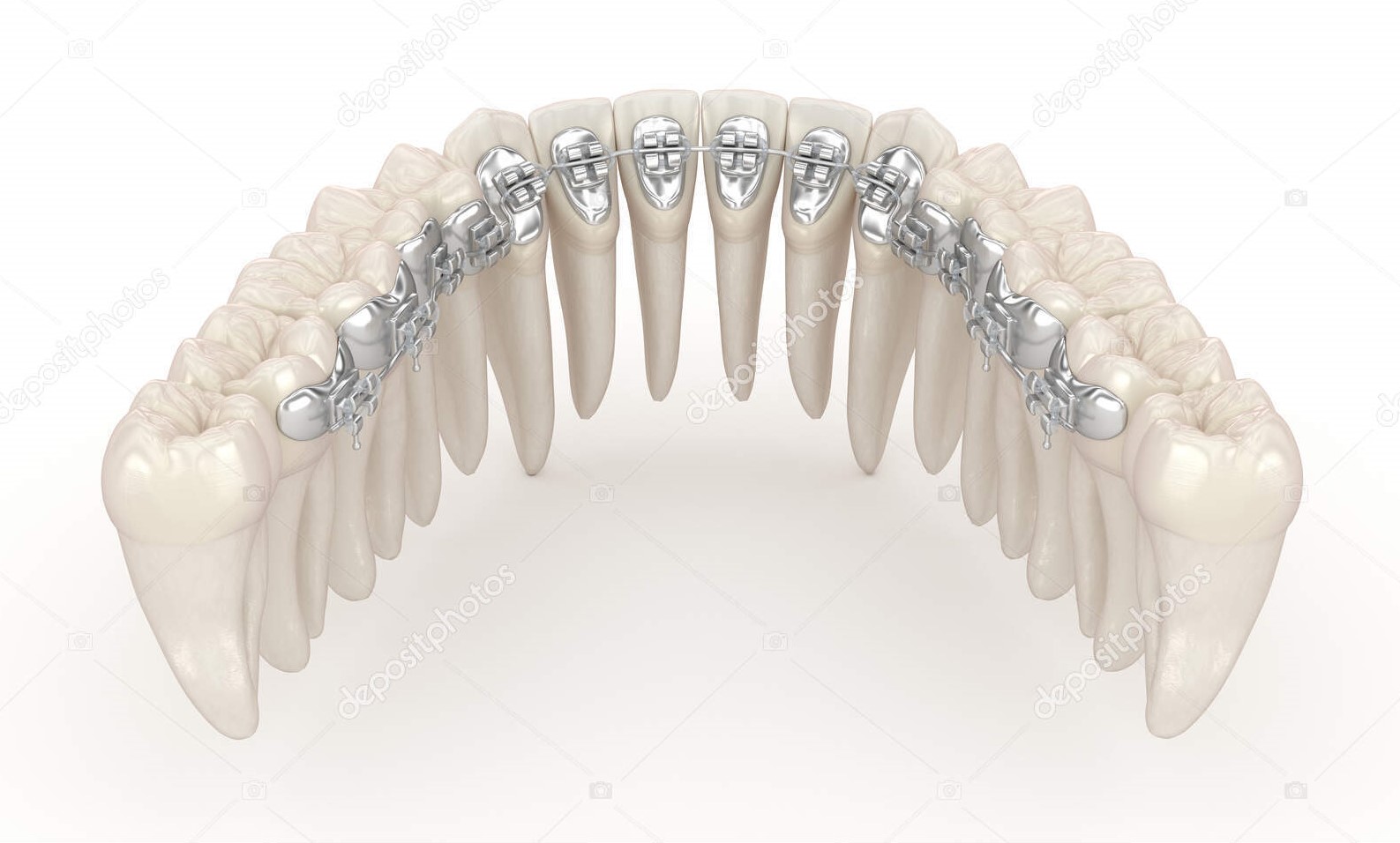 Lingual braces system. 3D illustration concept of silver braces