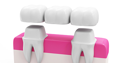 dental-crown-bridge-malaysia-dentistsco